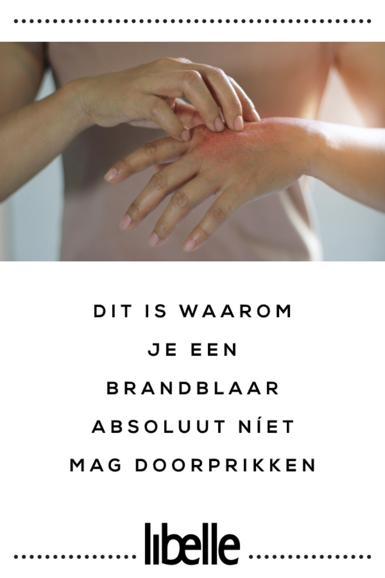 Blaar Onder Voet Doorprikken Wel Of Niet Doen?